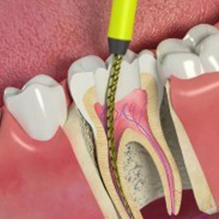 Endodoncja (leczenie kanałowe)